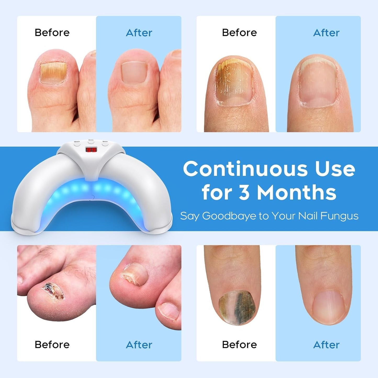 Easy Nail Health Laser Device